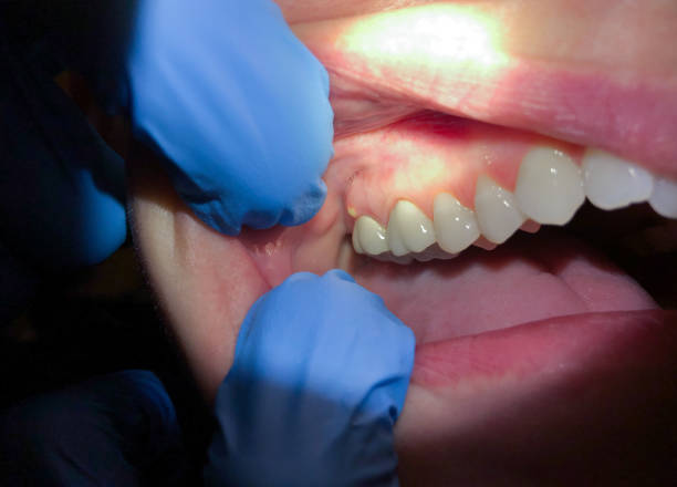 Best Emergency Care for Gum Disease in Monee, IL
